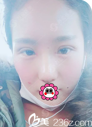 眼、鼻综合整形7天拆线后的样子 眼、鼻综合整形7天拆线后的样子