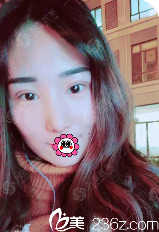 术后15天眼镜盒鼻子恢复情况 术后15天眼镜盒鼻子恢复情况