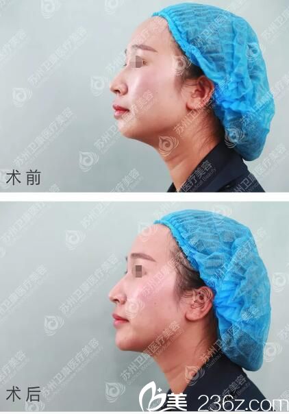 玻尿酸丰下巴术后即刻效果对比