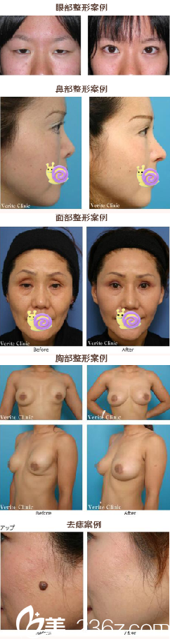 整形案例前后对比 整形案例前后对比