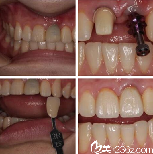 迪里夏提·吐拉洪副主任牙齿种植美学修复案例
