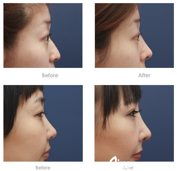 仝润泽隆鼻案例 仝润泽隆鼻案例