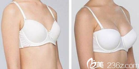 王家林医生自体脂肪丰胸案例