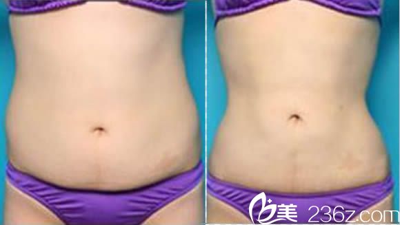 王家林腰腹部吸脂前后对比效果图