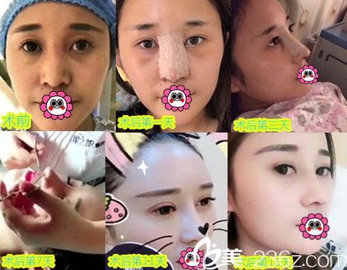 安庆星之地整形美容医院姜春兰做鼻综合隆鼻术后恢复过程图