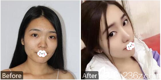 东莞缔美陈星光医生做的隆鼻案例