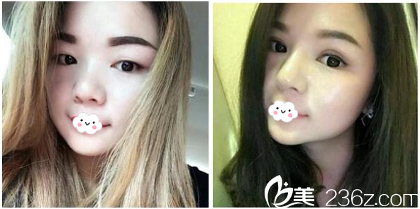 东莞缔美整形医院陈星光双眼皮案例