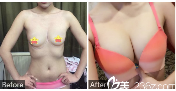 东莞缔美整形医院陈星光隆胸案例