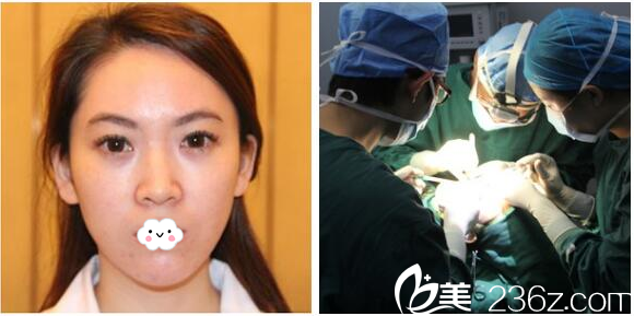 隆鼻术前照片 隆鼻术前照片