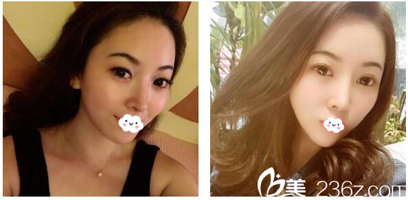 东莞缔美赵可隆鼻5个月生活照 东莞缔美赵可隆鼻5个月生活照