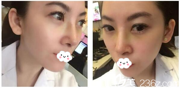 去东莞缔美隆鼻11天了 去东莞缔美隆鼻11天了