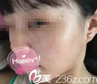 从平凉康美于晓萍给我做激光祛斑一个月的恢复图片中 看看我脸上有疤没