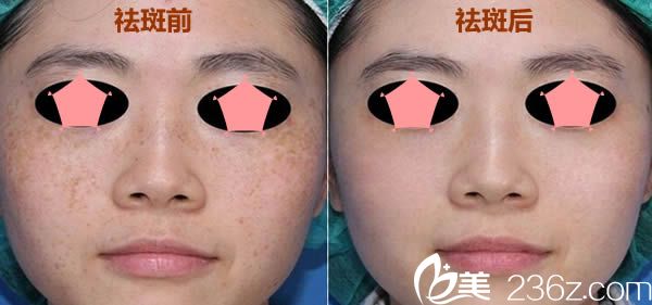宁德华美激光祛斑前后对比效果