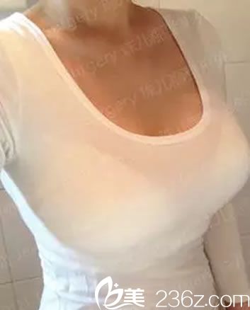 韩国珠儿丽假体隆胸手术5个月效果