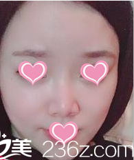 在北京王府井医院打了瘦脸两个月后，朋友说有了小V脸