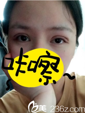 术后第二天 术后第二天