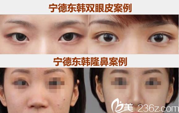 宁德东韩双眼皮和鼻综合隆鼻案例