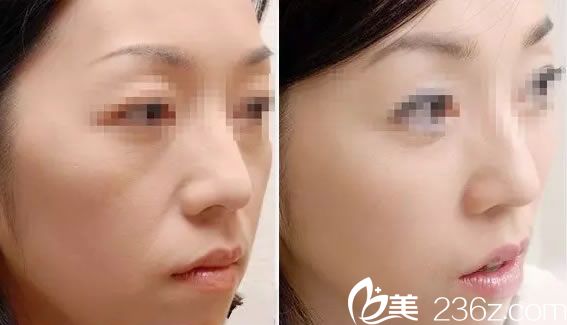 宁波壹加壹芙媄登玻尿酸填充面颊<span style= 宁波壹加壹芙媄登玻尿酸填充面颊<span style=