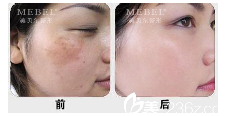 微针案例 微针案例