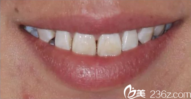 尤乐平牙修复术前 尤乐平牙修复术前