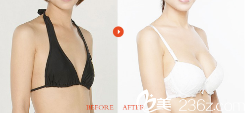 隆胸案例 隆胸案例