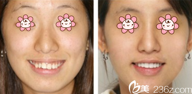 赵郡凡牙齿正畸案例