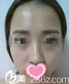 术前照片 术前照片