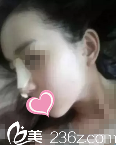 术后第三天 术后第三天