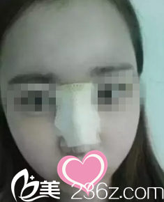 鼻整形术后第五天 鼻整形术后第五天
