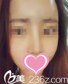 术后半个月效果 术后半个月效果