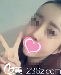 术后20天恢复情况 术后20天恢复情况