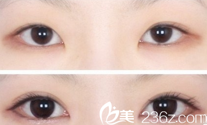 广州壹加壹项美莲埋线双眼皮失败修复案例 广州壹加壹项美莲埋线双眼皮失败修复案例