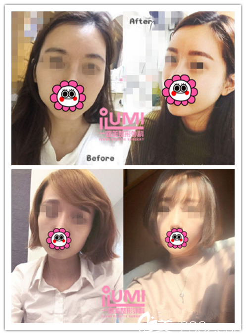 轮廓整形真人<span style= 轮廓整形真人<span style=