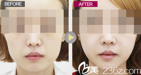 轮廓整形案例真人效果对比 轮廓整形案例真人效果对比