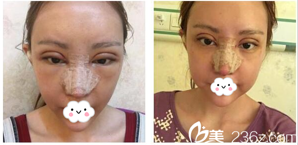 广州韩妃李光琴双眼皮隆鼻第2天 广州韩妃李光琴双眼皮隆鼻第2天