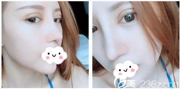 李光琴医生做的双眼皮隆鼻13天恢复情况 李光琴医生做的双眼皮隆鼻13天恢复情况