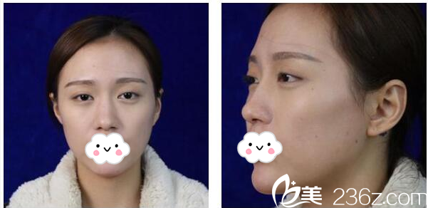 整形术前照片 整形术前照片