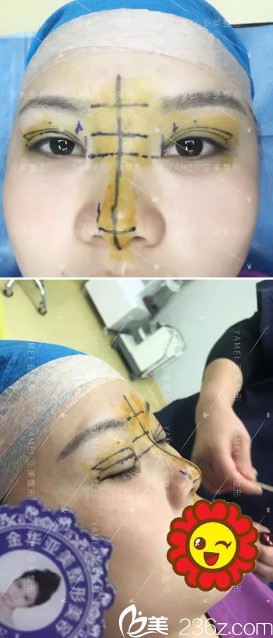 金华亚美院长为小王设计手术方案