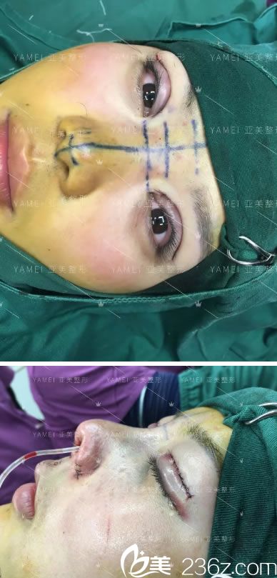 金华亚美眼鼻综合整形手术即刻<span style=