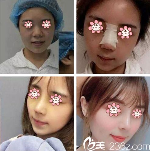 李诚桓隆鼻案例