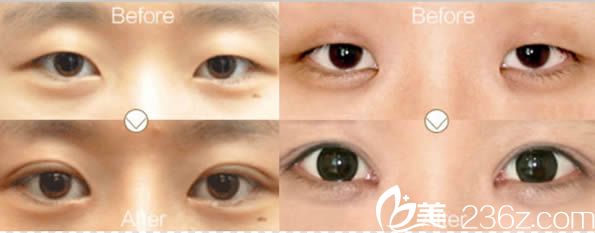 纯韩natural双眼皮和开眼角案例
