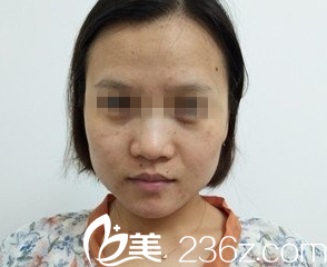 重庆光博士案例术前 重庆光博士案例术前