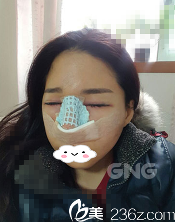 术后第三天 术后第三天