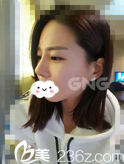 术后两周 术后两周