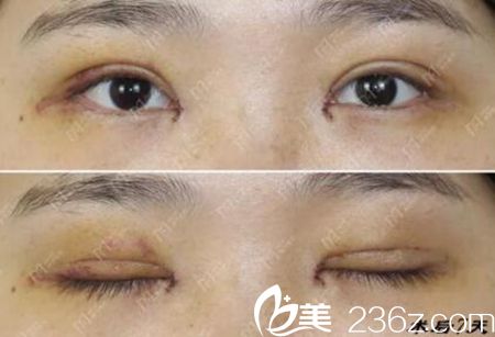 在郑州美艺割双眼皮4个月反馈 孔宇院长技术真是赞