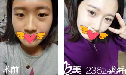 武汉爱思特双眼皮隆鼻案例分享眯眯眼也能迎来大眼春天