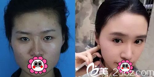 我在长春麦西美嘉做改脸型+眼鼻整形前后对比