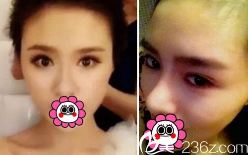 我在长春麦西美嘉做改脸型+眼鼻整形术后3个月