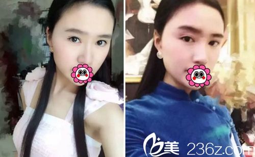 我在长春麦西美嘉做改脸型+眼鼻整形术后半年