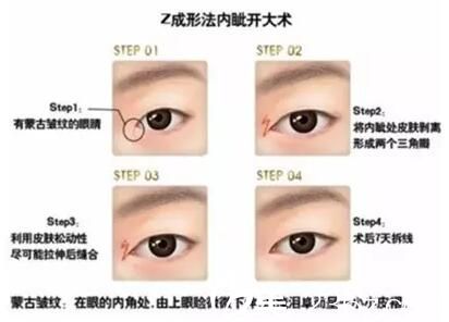 长春麦西美嘉Z成形法开内眼角效果 长春麦西美嘉Z成形法开内眼角效果